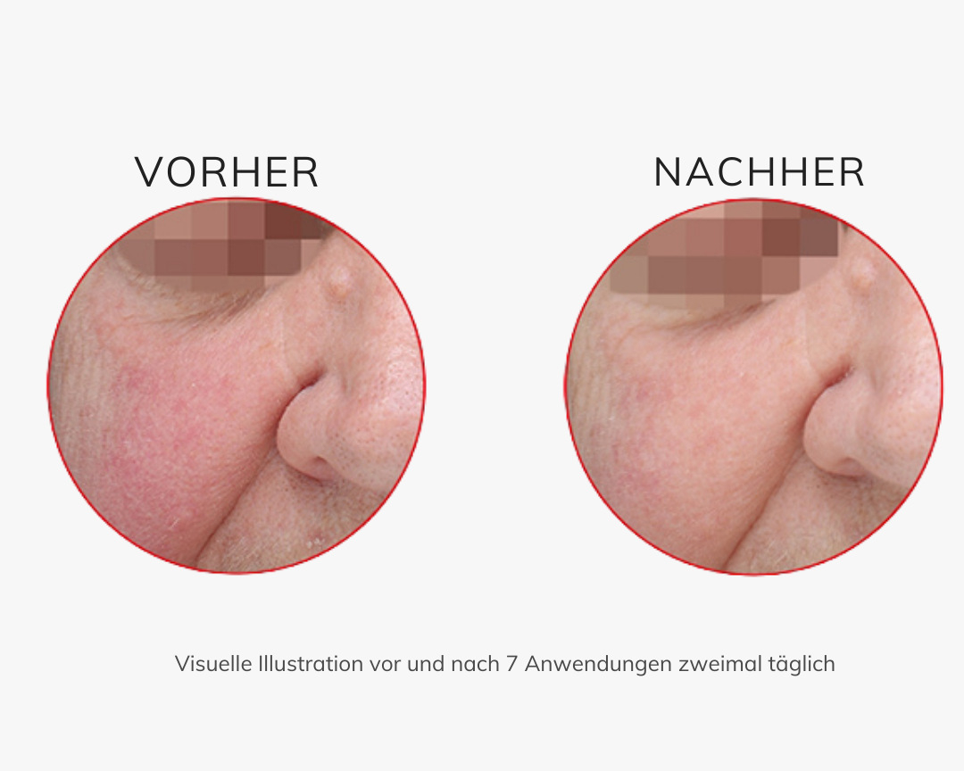 Swissforce® Anti-rougeurs - 30ml